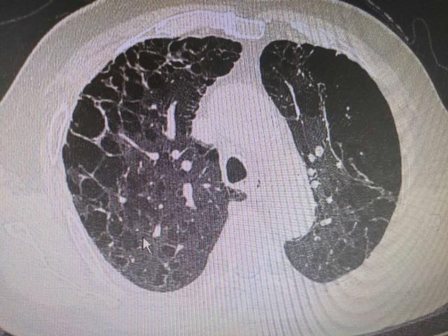 怎样看肺气肿ct图片图片