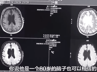 上海男子长期熬夜刷手机，确诊血管性痴呆，大脑萎缩如80岁！治疗后，仍存在反应迟钝等问题；六大“隐形伤脑”行为，你可能天天在做